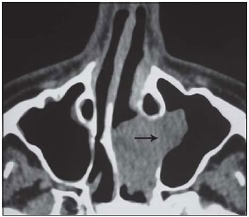 papiloma nasal tomografia