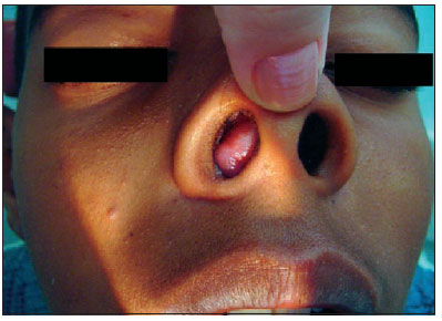 Papiloma nasal benigno - Manual Fisiopatología, Papiloma nasal benigno Papiloma nasal benigno
